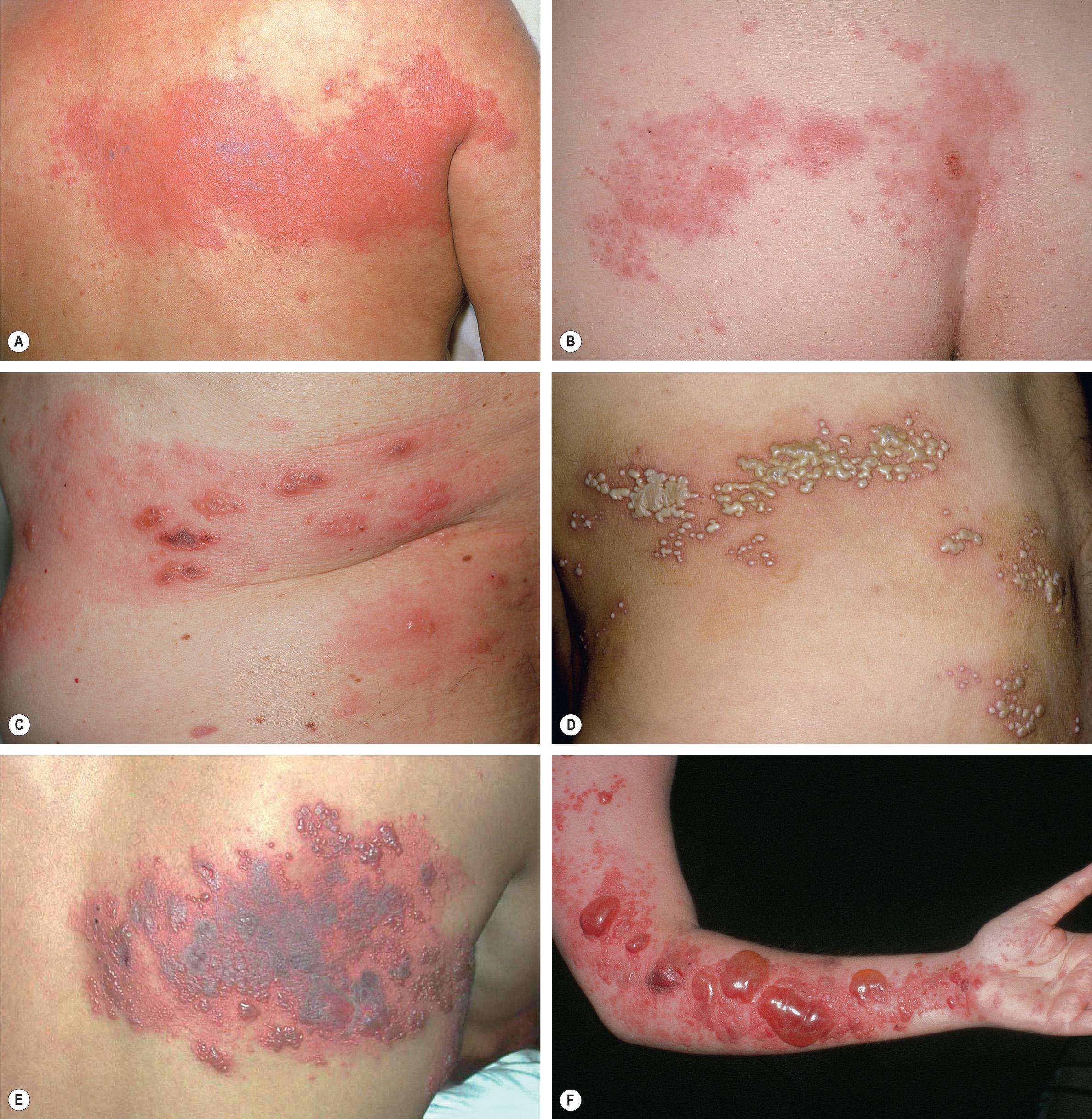 Fig. 80.15, Herpes zoster.