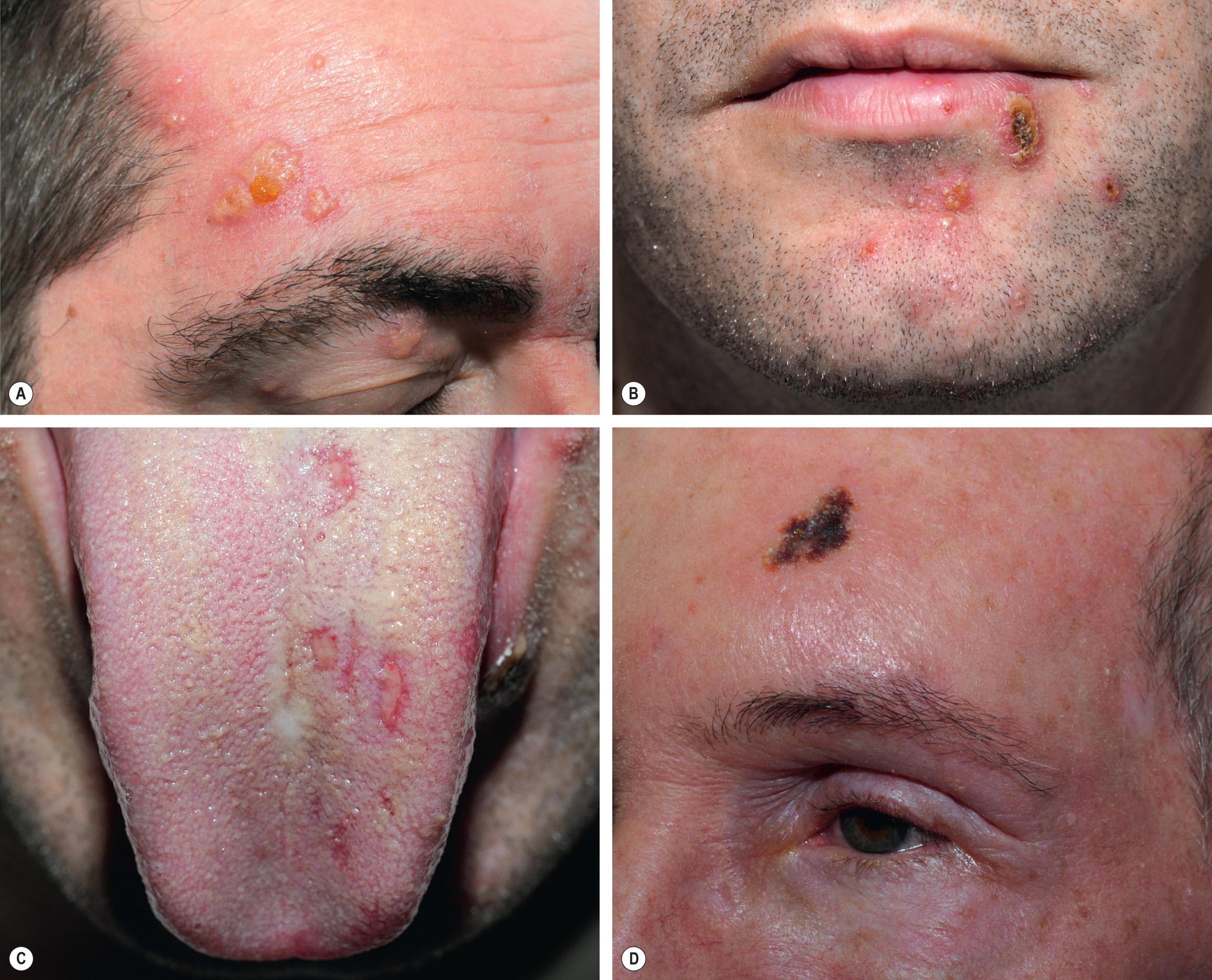 Fig. 80.16, Facial herpes zoster.