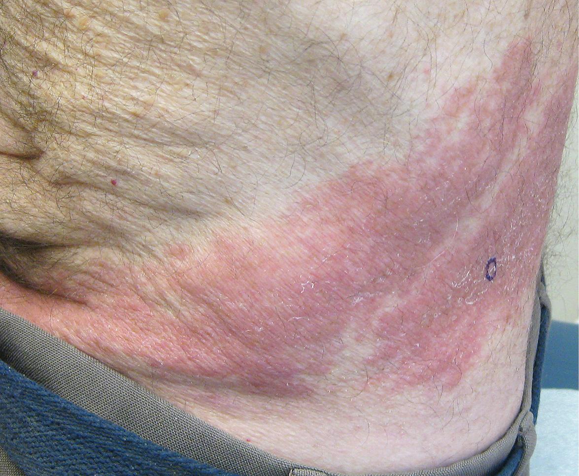 Fig. 80.17, Granulomatous dermatitis in the site of previous herpes zoster.