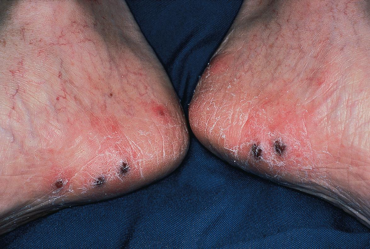 Fig. 80.19, Disseminated cutaneous zoster with multiple violet–black papules on the feet.