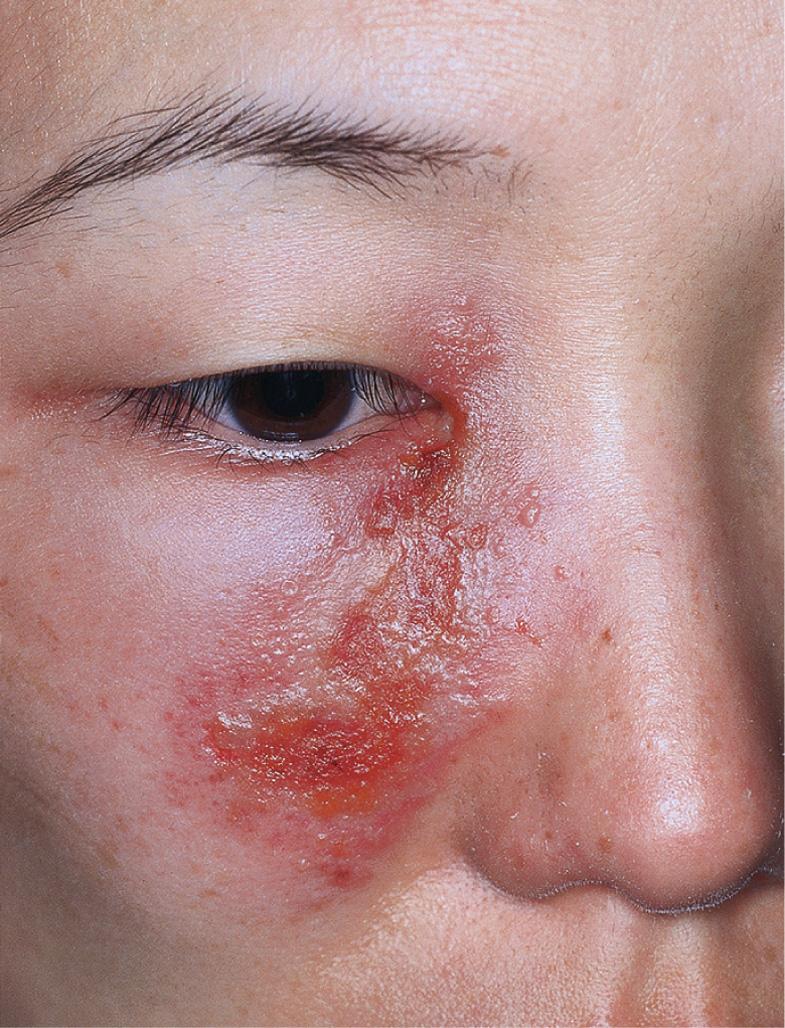 Fig. 80.2, Recurrent herpes simplex virus type 1 infection on the cheek.