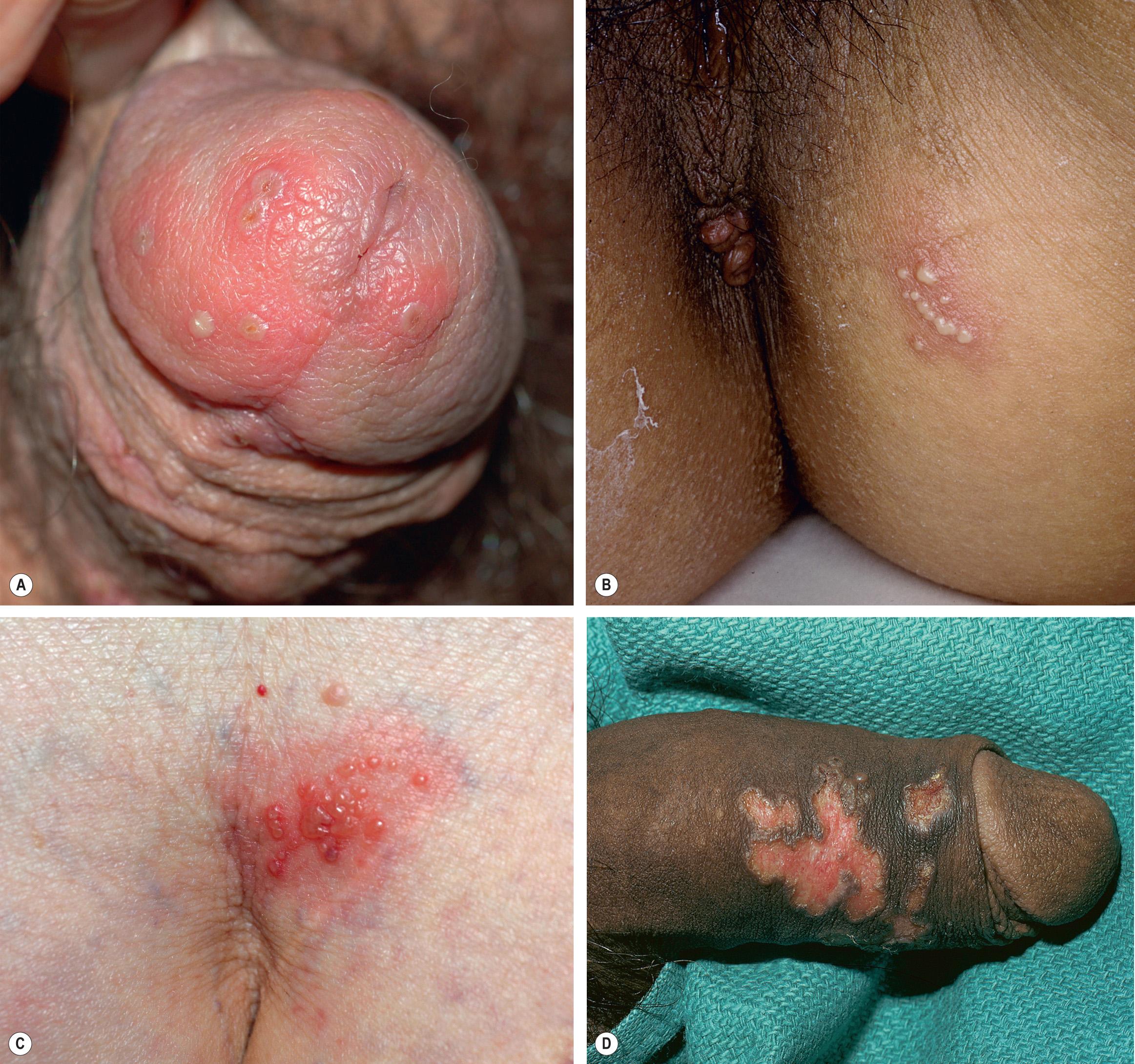 Fig. 80.4, Recurrent genital herpes.