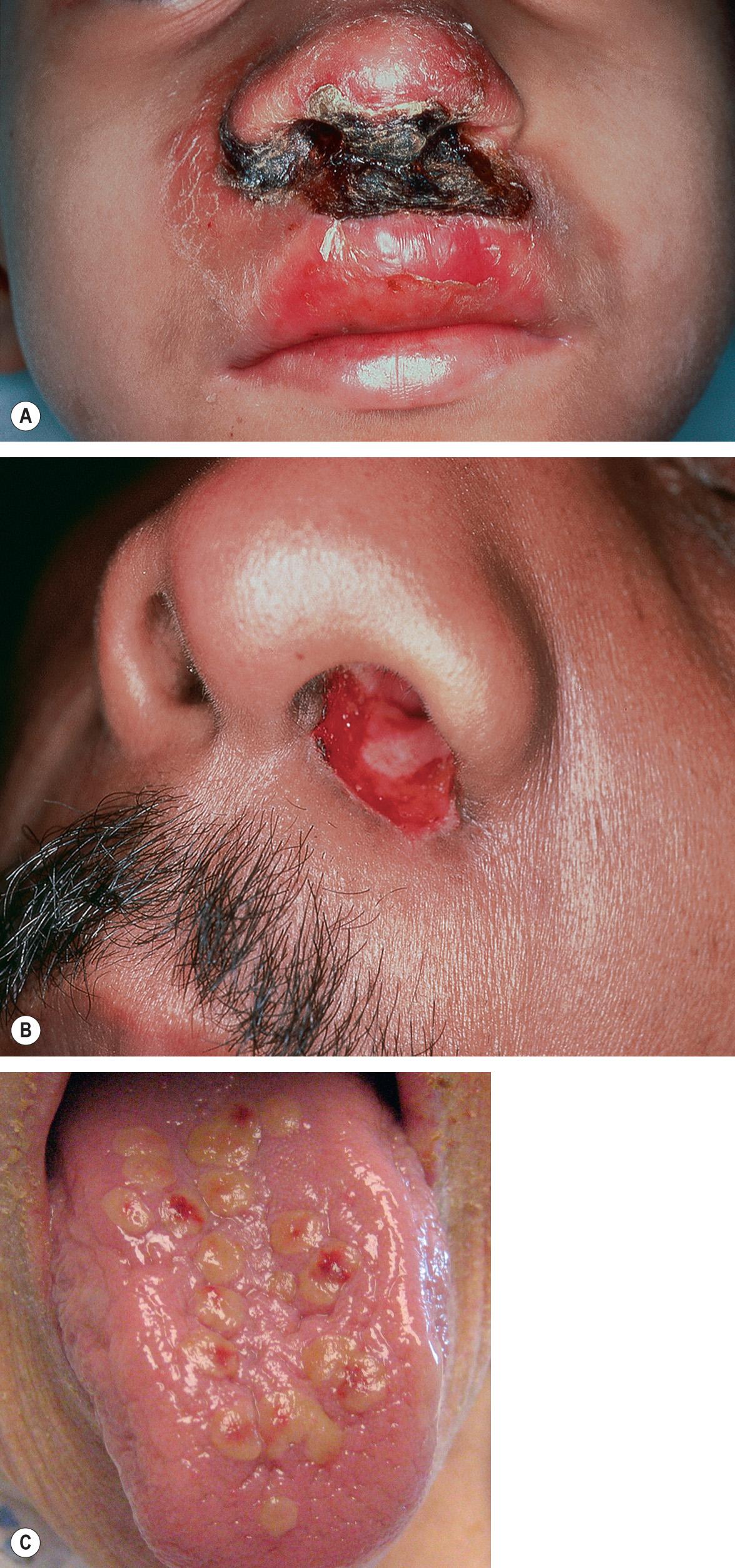 Fig. 80.8, Herpes simplex virus infections in immunocompromised hosts.