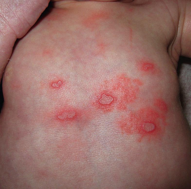 Fig. 80.9, Neonatal herpes.