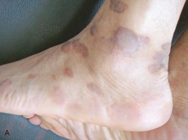 Figure 62.1, Kaposi sarcoma. (A–B) Skin lesions of Kaposi sarcoma on leg and plantar aspect feet. (C) Histologic appearance including spindle cell proliferation, red blood cell extravasation, and inflammatory cell infiltration.