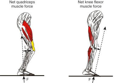 FIG 6-1, The intersegmental flexion-extension moment can be visualized by considering a ground reaction force vector that passes posterior to the knee will produce an external flexion moment that is balanced by a net internal quadriceps moment. When the vector passes anterior to the knee, an external extension moment is produced that must be balanced by a net internal flexor muscle moment. F, Ground reaction force; L, lever arm.