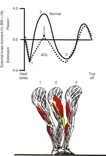 FIG 6-2, The pattern of the external flexion-extension moment during normal walking for anterior cruciate ligament (ACL)-deficient ( dashed line ) and normal ( solid line ) knees. Typically, patients with ACL-deficient knees have a reduced moment, tending to flex the knee (net quadriceps moment) during midstance. The figure of the leg indicates the position of the knee joint and the net muscular activation ( shaded area ) required to balance the external moment shown in the graph. BW, Body weight; Ht, height.
