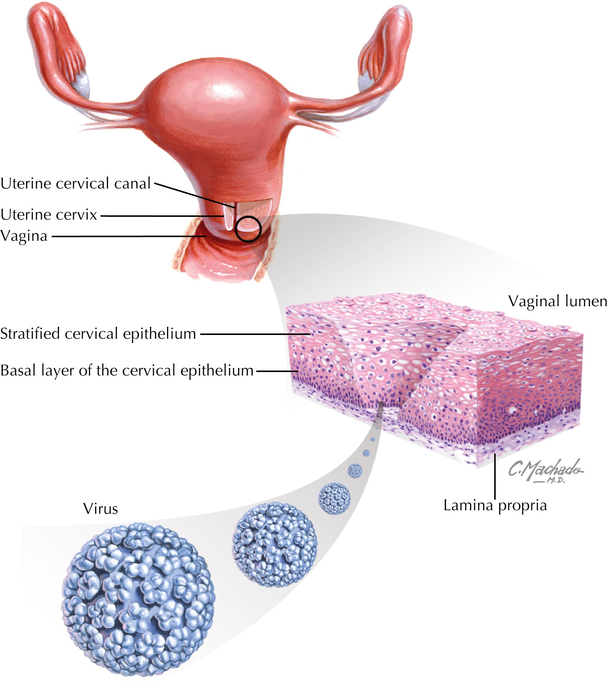 Fig. 16.1, Human papillomavirus (HPV) cervical infection. HPV initially replicates in the basal cell layer of the cervical epithelium, and HPV progeny virions are then released from cells at the mucosal surface.