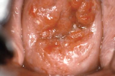 Figure 4-2, Cervical squamous cell carcinoma.