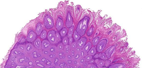 Figure 4-3, Common wart (also known as verruca vulgaris) with a prominent papillomatous growth pattern.