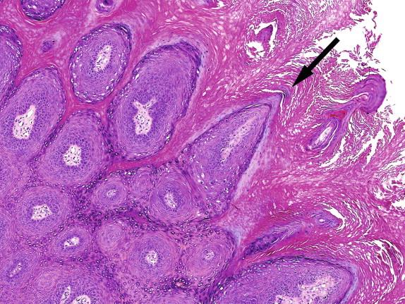 Figure 4-4, Higher-power view of the wart shown in Figure 4-2 , illustrating the prominent spires of hyperkeratosis and parakeratosis (arrow).