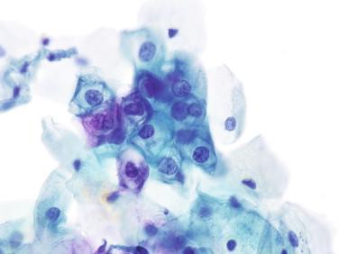 Figure 4-5, Low-grade squamous epithelial lesion on Papanicolaou-stained cervical smear (600 ×). There is prominent koilocytic change in the cells at the center of the image with cytoplasmic vacuolation and enlarged nuclei with irregular contours.