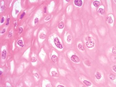 Figure 4-6, Low-grade intraepithelial lesion (LSIL/CIN1) of the cervix (H&E, 400 ×). The epithelium contains cells with enlarged nuclei and prominent surrounding cytoplasmic halos (koilocytes).