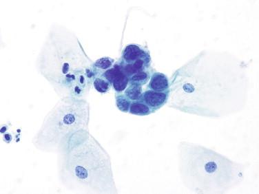 Figure 4-7, Cluster of cells with high N/C ratios, irregular nuclear contours, and coarsely granular nuclear chromatin consistent with HSIL (Papanicolaou-stained cervical smear, 600 ×).