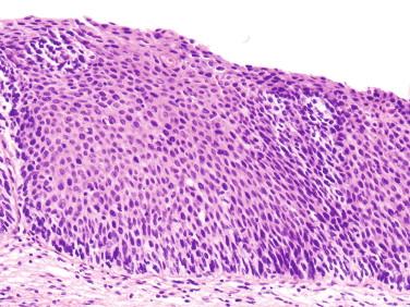 Figure 4-8, High-grade squamous intraepithelial lesion on histology (H&E, 400 ×). Note that the atypical cells have a high N/C ratio and encompass more than two thirds of the epidermal thickness, with only minimal surface differentiation.