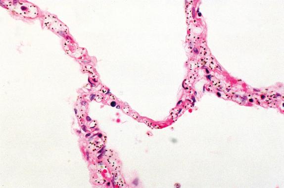 FIG. 14.1, Plasmodium falciparum infection. The hemozoin pigment produced by Plasmodium species is readily detected in routinely stained sections. Prominent involvement of the pulmonary alveolar capillaries is demonstrated here.