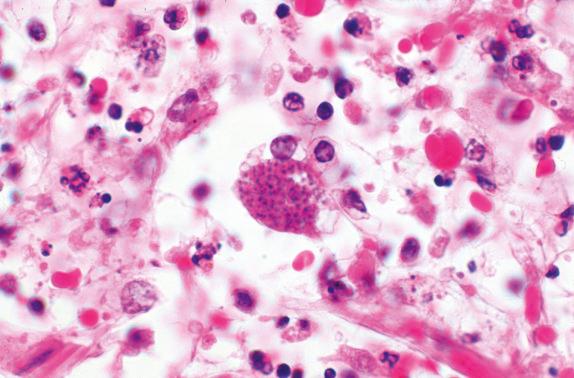 FIG. 14.3, Toxoplasma gondii. A cyst filled with bradyzoites is present in this patient with pulmonary involvement by T. gondii.