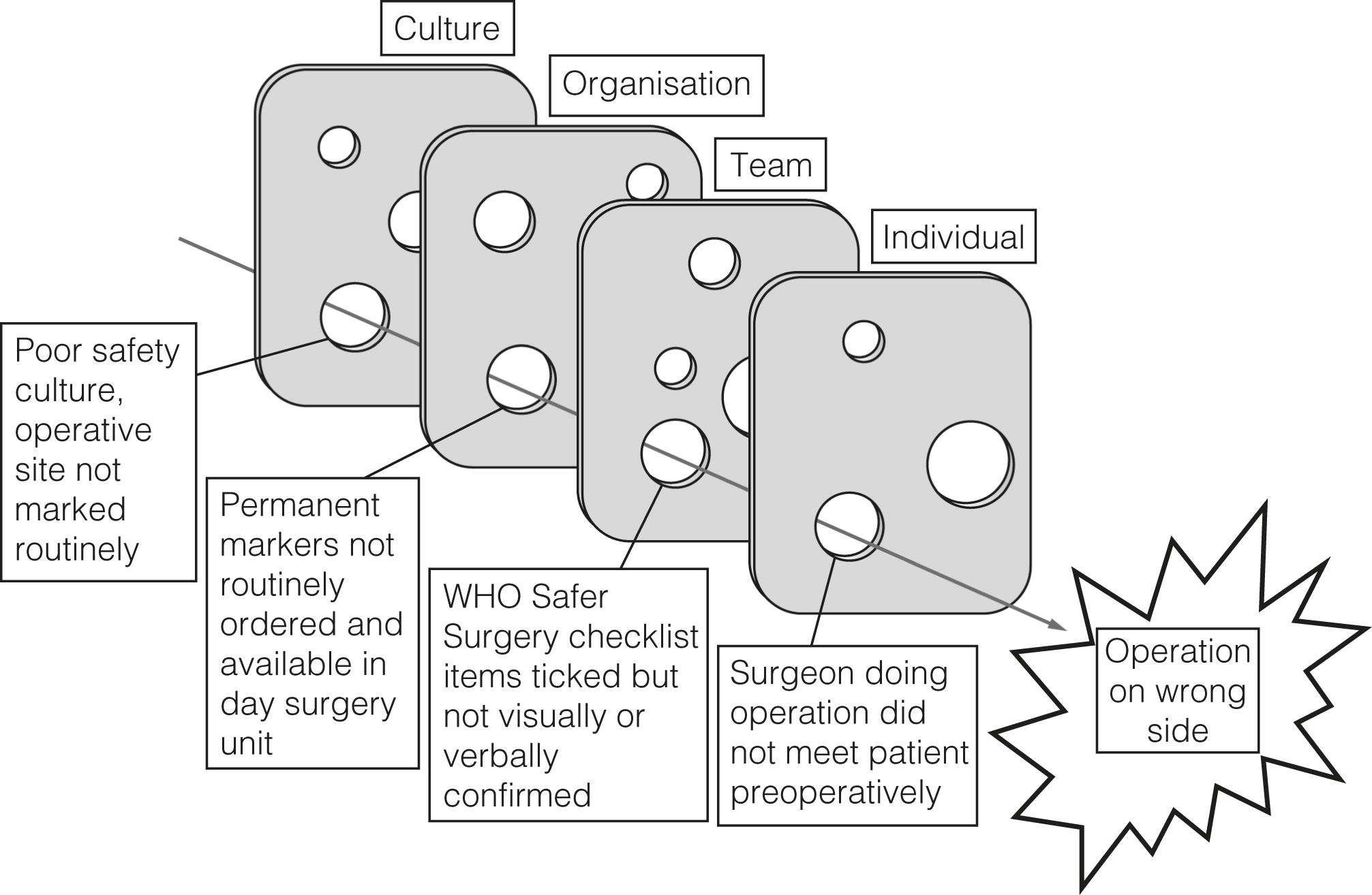 Figure 9.3, The Swiss cheese model applied to a case of wrong site surgery. The slices of cheese are defensive layers within the healthcare system, the holes are transient or permanent gaps in these defences. When the holes align, a significant adverse event occurs.