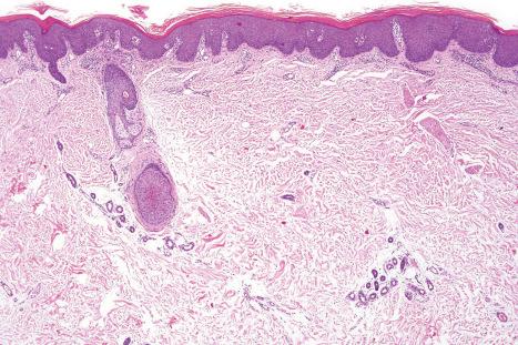 Fig. 19.11, HIV-associated pityriasis rubra pilaris: low-power view showing a thickened stratum corneum and psoriasiform hyperplasia.