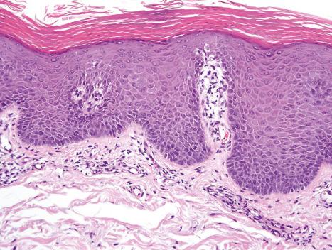 Fig. 19.12, HIV-associated pityriasis rubra pilaris: there is alternating orthohyperkeratosis and parakeratosis.