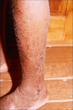 Fig. 19.13, HIV-associated xerosis: marked scaling has resulted in an eczema craquelé-like appearance. Dry skin is a common complaint in patients with HIV infection.