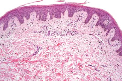 Fig. 19.14, HIV-associated xerosis: there is hyperorthokeratosis and parakeratosis associated with psoriasiform hyperplasia. There is only minimal spongiosis on the right side of the figure.