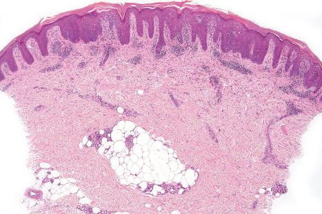 Fig. 19.15, HIV-associated lichenoid photoeruption: there is marked hyperkeratosis with psoriasiform hyperplasia. A dense interstitial and perivascular chronic inflammatory cell infiltrate is present in the upper dermis.