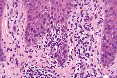 Fig. 19.16, HIV-associated lichenoid photoeruption: high-power view showing interface change, lymphocytic exocytosis, and a dense infiltrate in the papillary dermis. There is pigment incontinence.