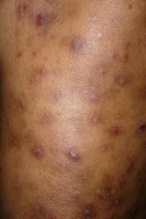 Fig. 19.18, HIV-associated pruritic papular eruption: there are numerous small erythematous papules.