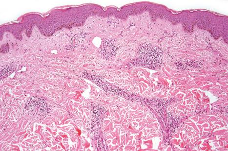 Fig. 19.19, HIV-associated pruritic papular eruption: there is focal mild acanthosis. Within the dermis is a dense perivascular infiltrate, and vessels are dilated.