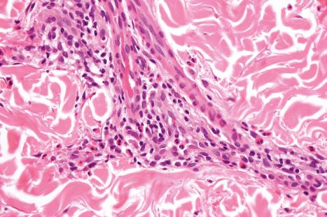 Fig. 19.20, HIV-associated pruritic papular eruption: the infiltrate consists of lymphocytes and numerous eosinophils.