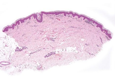 Fig. 19.2, Acute HIV exanthem: early lesion showing a superficial perivascular lymphocytic infiltrate.