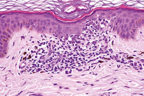 Fig. 19.3, Acute HIV exanthem: there is a tiny focus of lymphocytic exocytosis.