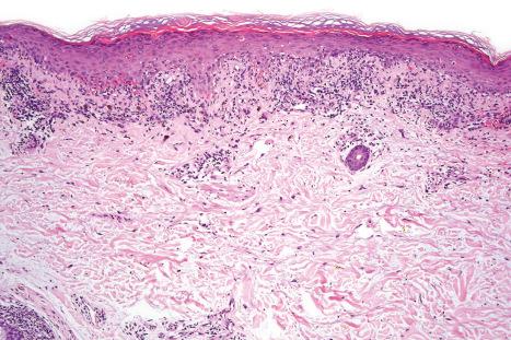 Fig. 19.4, Acute HIV exanthem: established lesion showing hyperkeratosis, irregular acanthosis, and interface change associated with an upper dermal bandlike infiltrate.