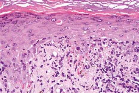 Fig. 19.5, Acute HIV exanthem: high-power view showing interface change and cytoid bodies with pigment incontinence.