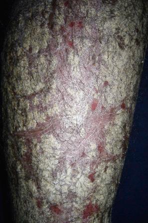 Fig. 19.7, HIV-associated psoriasis: in this patient, the lesions are much more extensive.