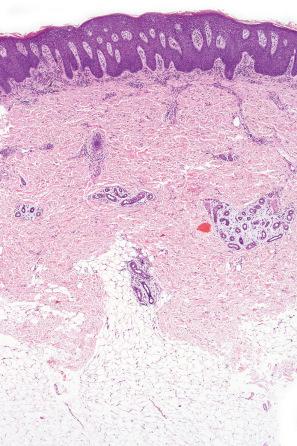 Fig. 19.8, HIV-associated psoriasis: low-power view showing parakeratosis. Psoriasiform hyperplasia with fused club-shaped rete ridges and an upper dermal perivascular inflammatory cell infiltrate.