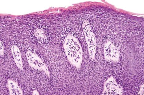 Fig. 19.9, HIV-associated psoriasis: a neutrophil Munro microabscess is present. There is mild spongiosis of the underlying dermis and vascular dilatation.