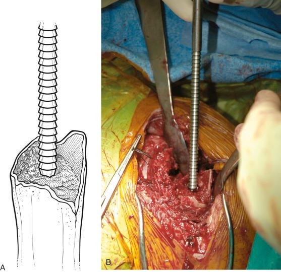 FIGURE 29.3, (A and B) Reaming of the humeral shaft.