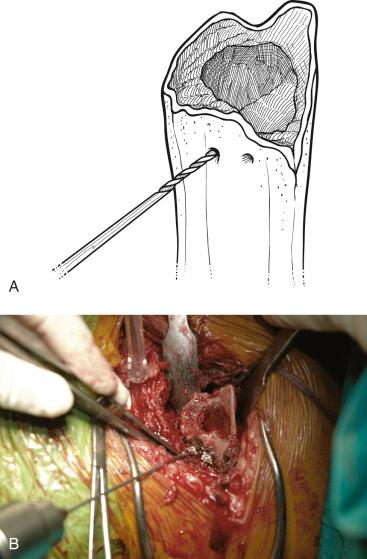 FIGURE 29.5, (A and B) Holes are drilled on each side of the bicipital groove in the humeral shaft for later fixation of the tuberosities.