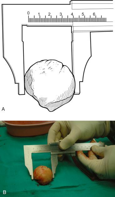 FIGURE 29.6, (A and B) Selection of the appropriate humeral head prosthetic diameter. The lesser diameter from the native humeral head is selected.