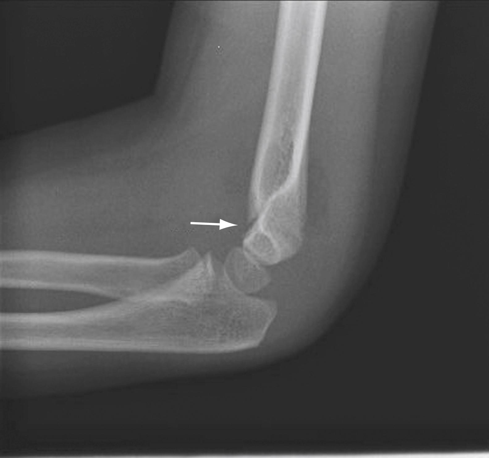 Fig. 44.11, Supracondylar fracture (arrow) with anterior and posterior fat pad.