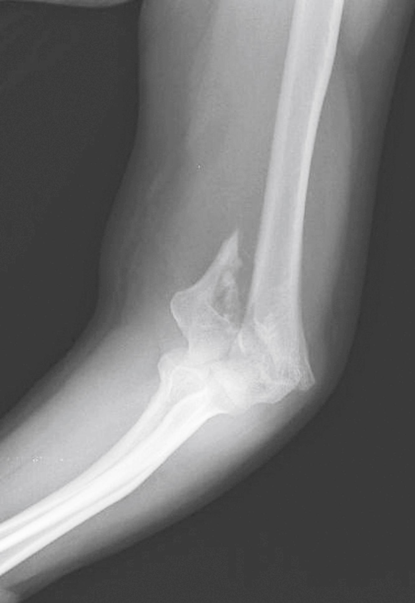 Fig. 44.16, Type III supracondylar fracture with significant displacement of distal fragment.