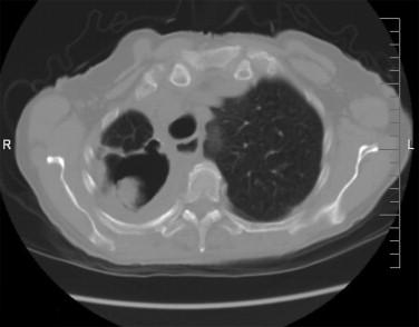 Figure 23-1, Aspergilloma in posterior aspect of cavitary lesion in right apex of lung.