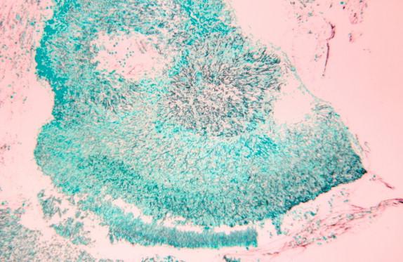 Figure 23-2, Aspergilloma of lung demonstrating banding pattern with denser staining at outer rim. PAS stain, 100 × magnification.