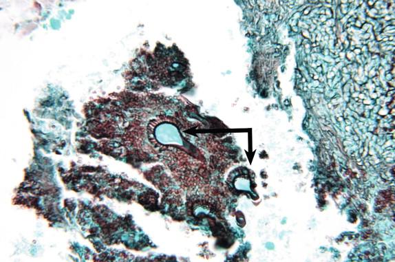 Figure 23-3, Fruiting heads of Aspergillus fumigatus at the periphery of aspergilloma. A. fumigatus is identified by the presence of only a single row of phialides between the vesicle and conidia, and the single row is attached to the upper portion of the vesicle (compare to Figure 23-24 ). Conidia are commonly stripped away in histologic preparations. GMS stain, 400 × magnification.