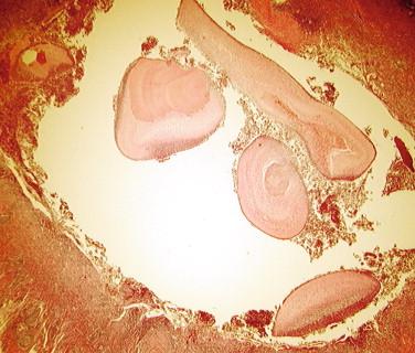 Figure 23-5, Coccidioides immitis fungus ball in lung cavity. H&E stain, 40 × magnification.