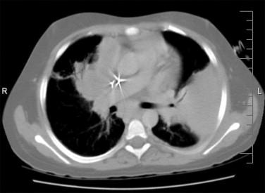 Figure 23-8, CT of lung of 10-year-old child with chronic granulomatous disease. Pulmonary consolidation was present bilaterally but was most severe in the left lower lobe. Mediastinal adenopathy was noted. More commonly, multiple lung nodules are visualized.