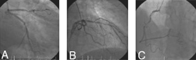 Figure 6.1, This coronary angiogram shows an example of an ideal candidate for hybrid coronary revascularization. (A) Focal lesion of the circumflex artery. (B) Complex, tandem lesion of the left anterior descending coronary artery. (C) Focal lesion of the right coronary artery.
