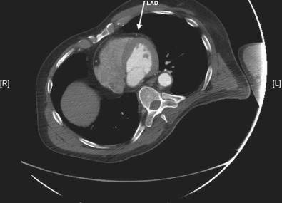 Figure 6.2, The arrow indicates the epicardial course of the left anterior descending coronary artery.